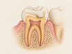 Cross-section of a back molar with a custom onlay bonded over the chewing surface and one cusp, revealing preserved enamel, dentin, pulp, and surrounding gum tissue to explain how this partial restoration repairs a damaged tooth.