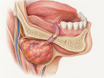 A cross-section of the lower jaw and floor of the mouth shows a submandibular gland and Wharton's duct, with a small salivary stone blocking the duct and backed-up saliva swelling the gland.